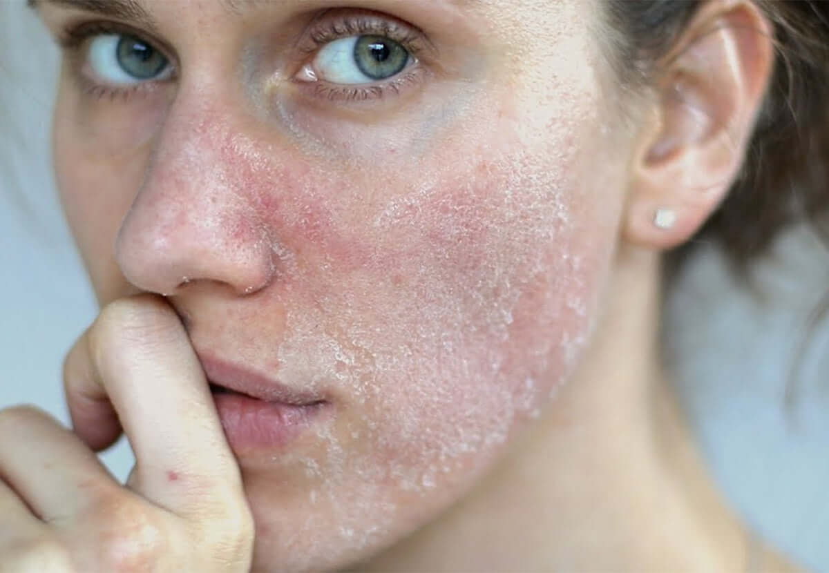 Woman with dry, flaky skin on cheeks, emphasizing the need for deep moisturization