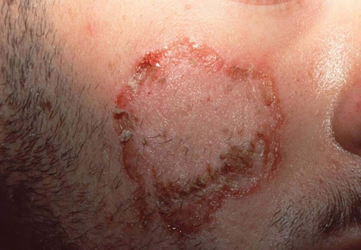 How to Spot & Treat Bacterial Skin Infections the Right Way