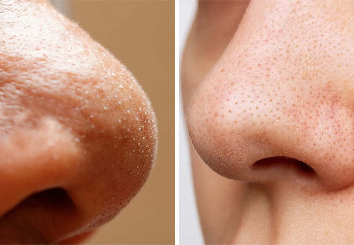 Close-up of nose with visible blackheads and clear skin after removal treatment