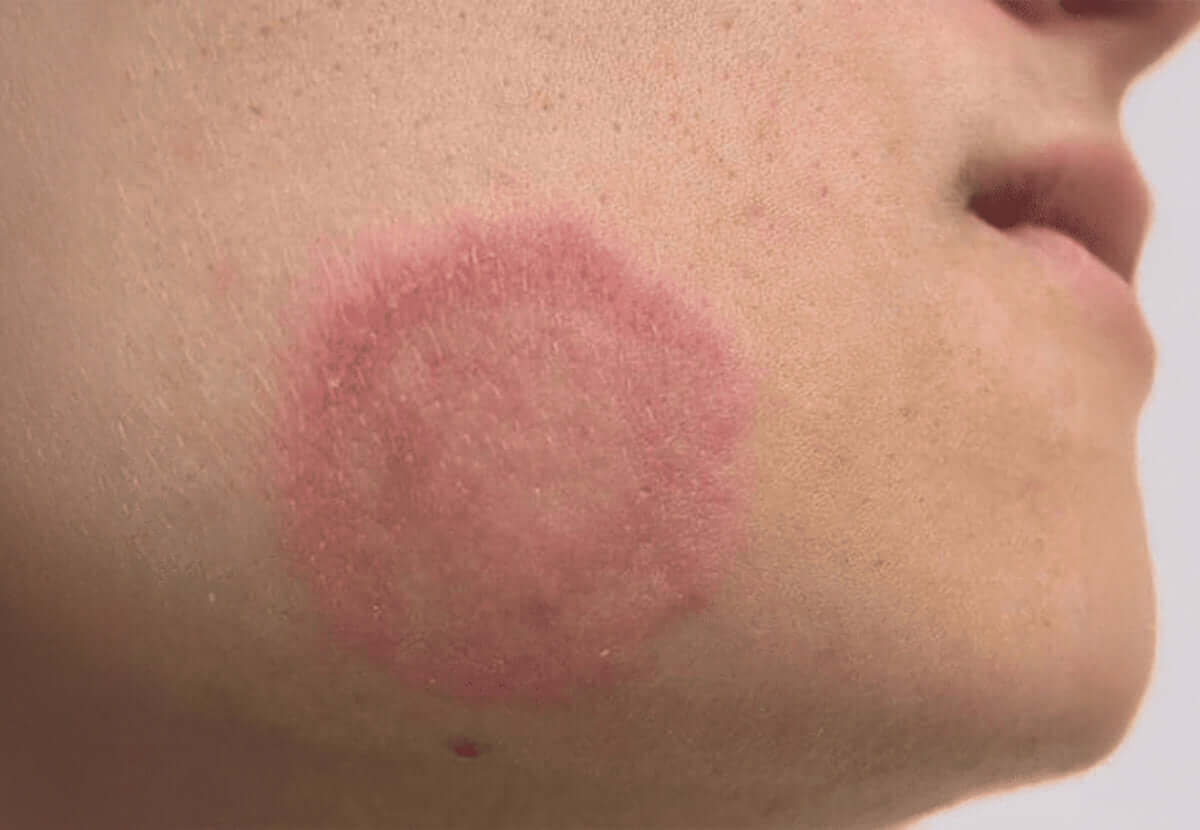 Fungal Skin Infections: Causes, Signs & Easy Prevention Tips
