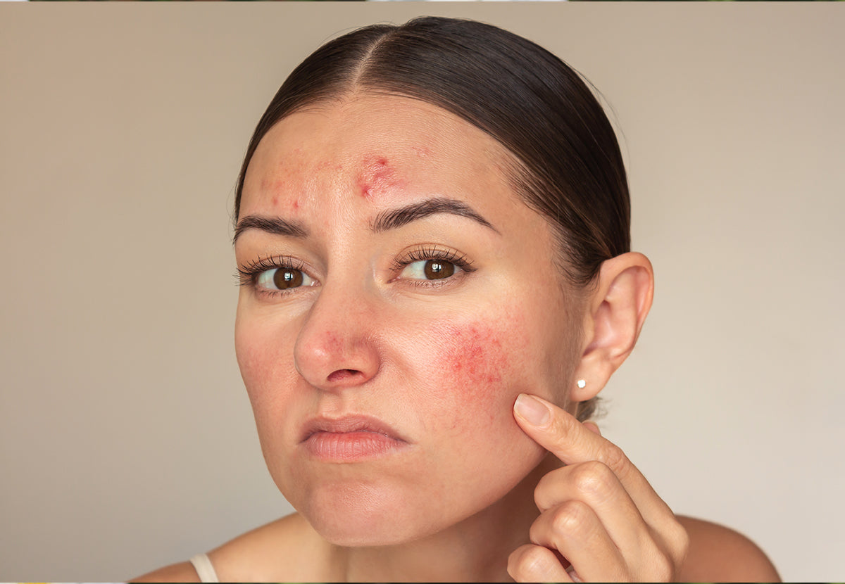 "Say Goodbye to Pimples: The Ultimate Indian Skin Guide to Clearer Skin"