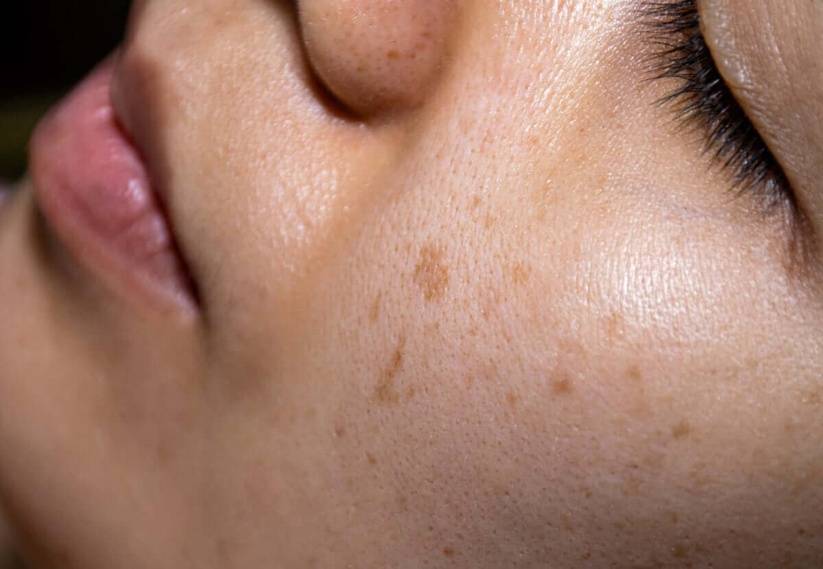Close-up of uneven skin tone with visible dark spots, highlighting the need for brightening care