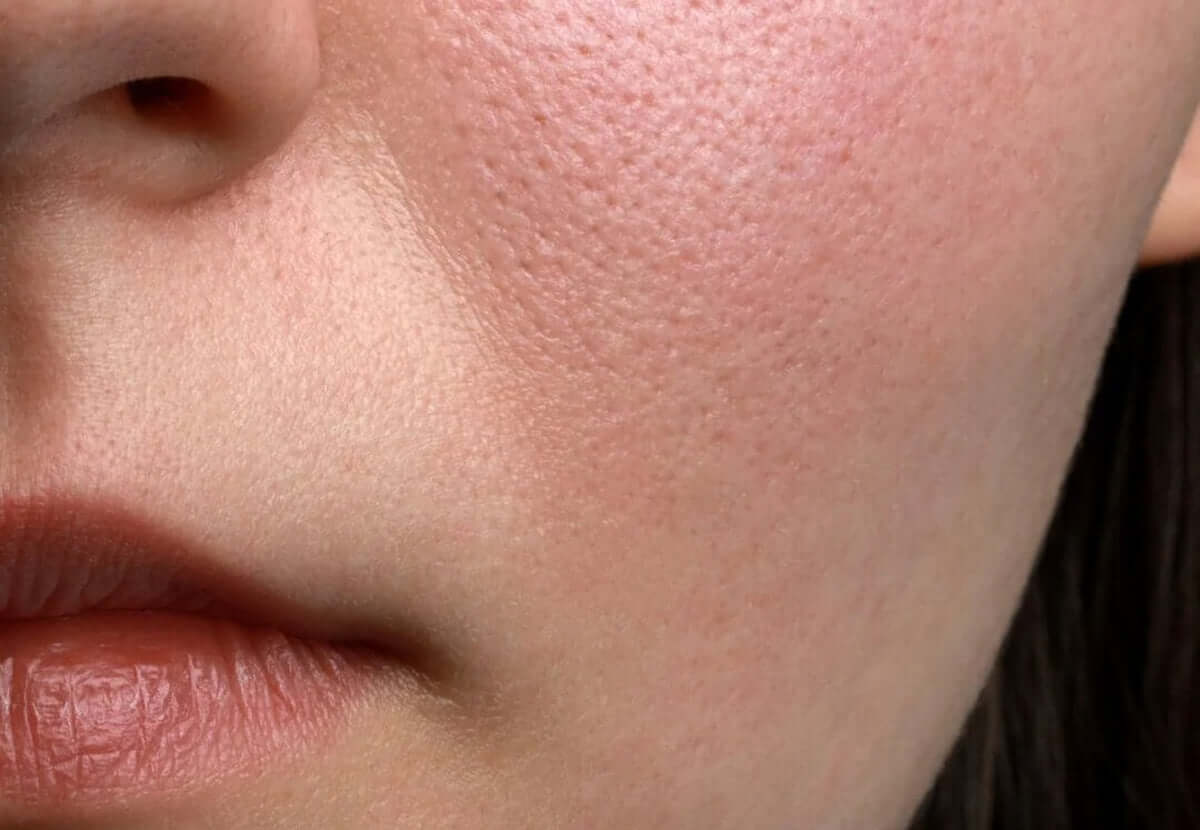 Close-up of enlarged pores on cheek area, emphasizing pore minimization solutions