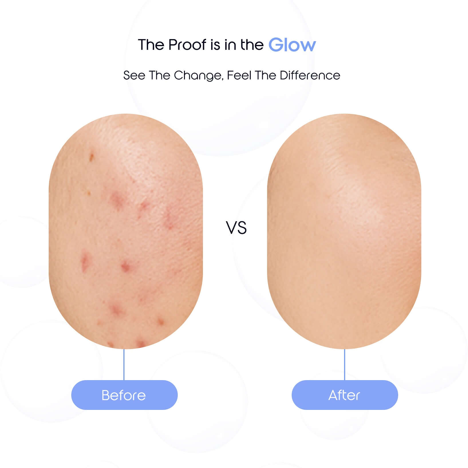Before and after comparison showing reduced acne and smoother skin after using Fresh Reset Cleanser