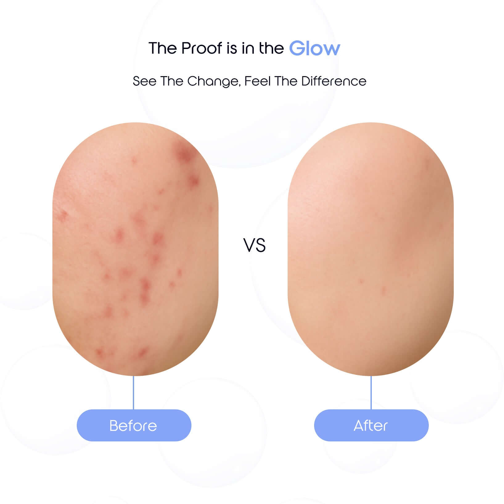 Before and after comparison showing reduced acne and smoother skin after using Pure Horizon Face Wash