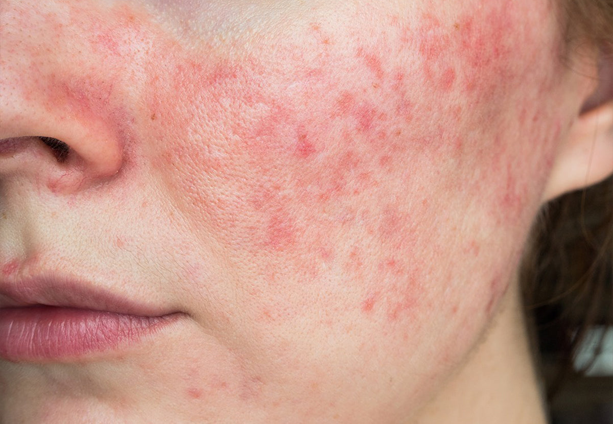 Face Allergies & Irritations (Contact Dermatitis)