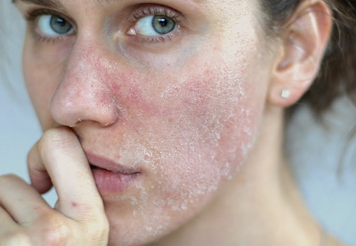 Dry Skin (Xerosis)