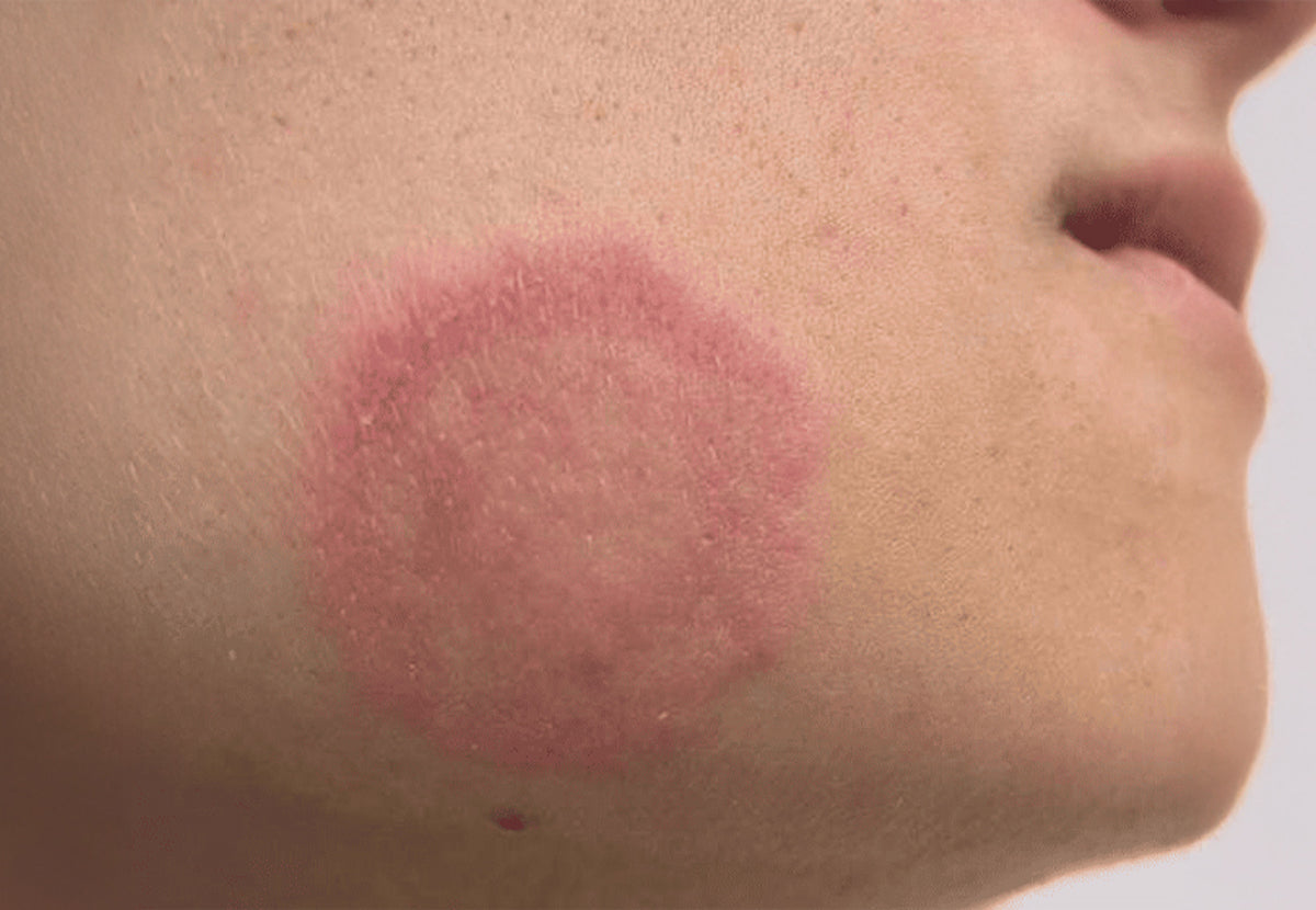 Fungal Skin Infections