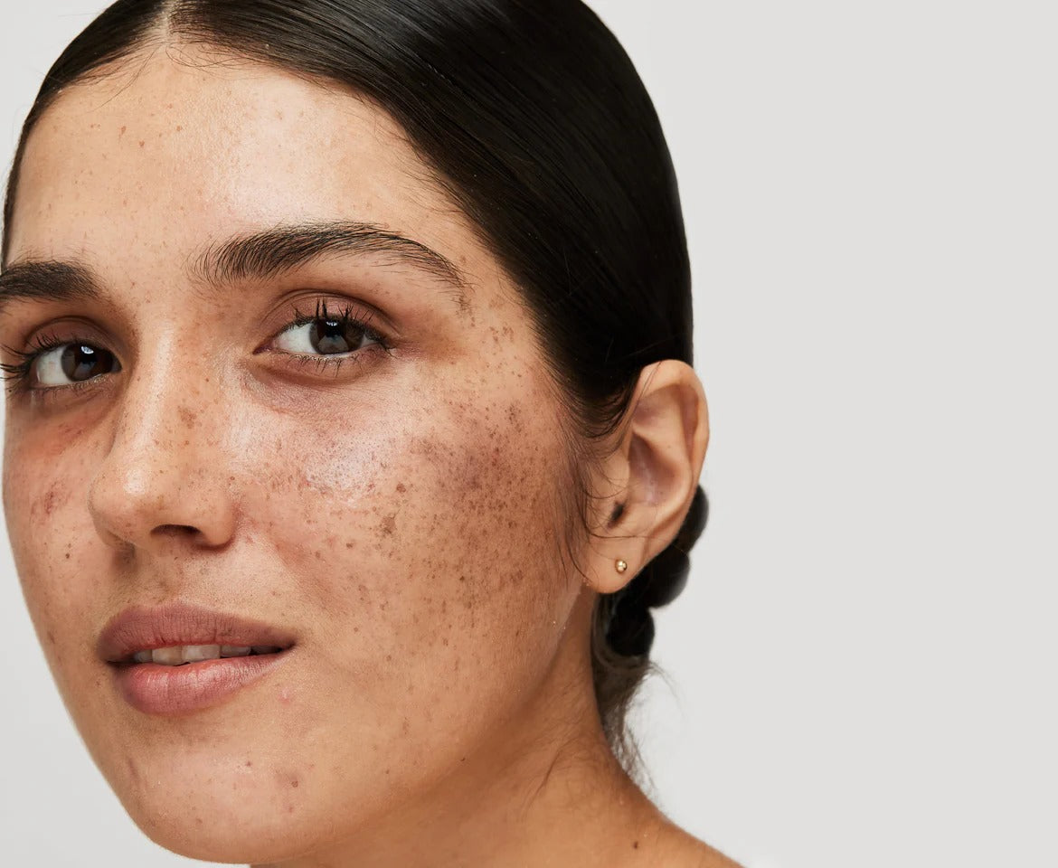 Uneven Skin and Dark Spots