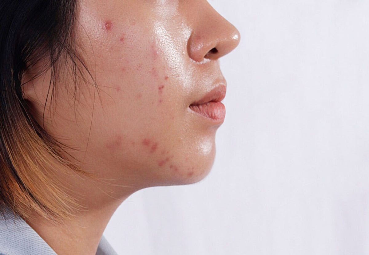 Oily Skin