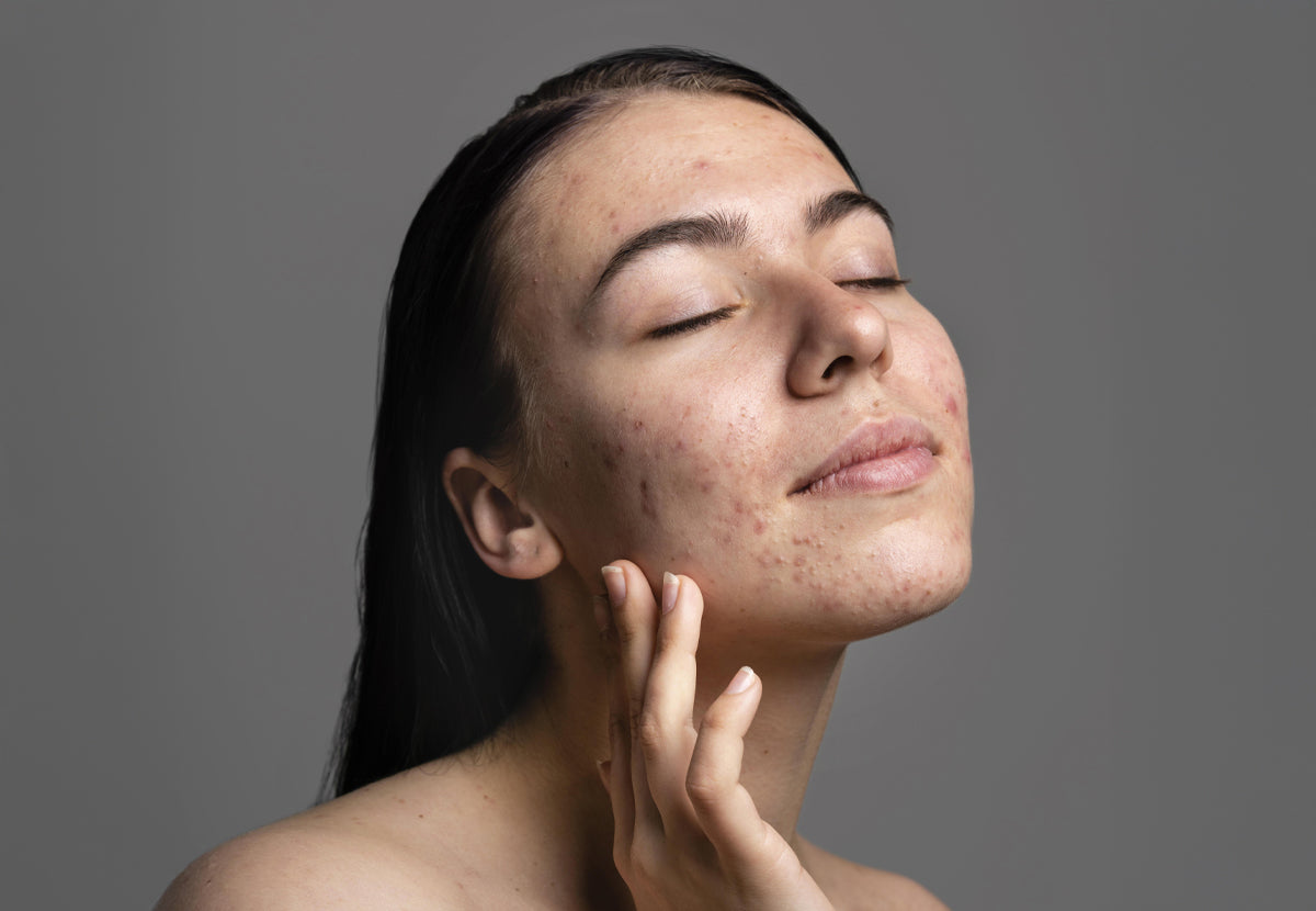 Acne (Pimples)
